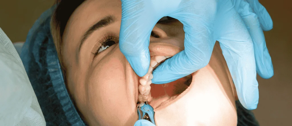 Tooth Extraction as a Solution
