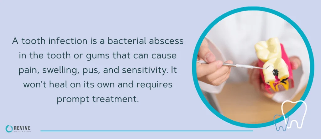 Understanding Tooth Infections and Dental Abscesses