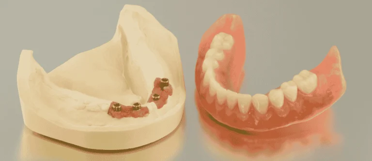 implant supported dentures vs dentures