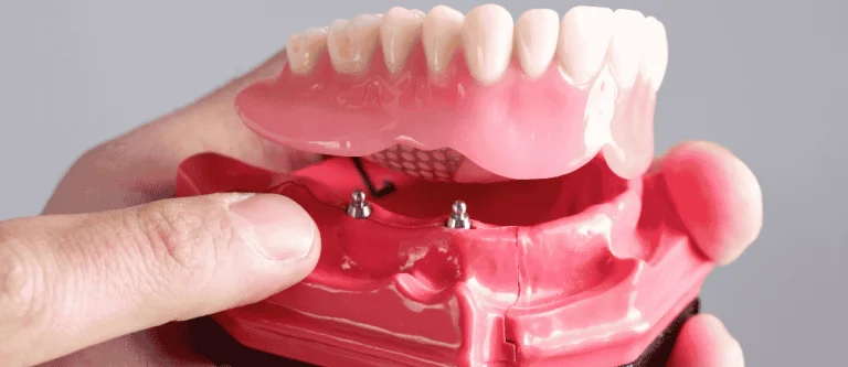 loose dentures implant solution